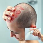 łojotokowe zapalenie skóry głowy